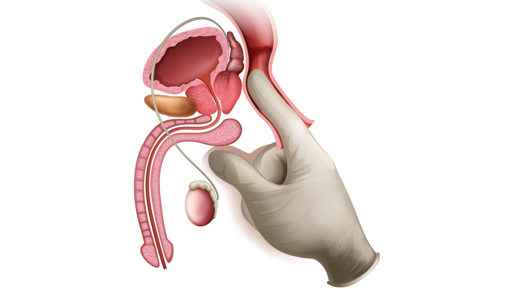 exame de cancer de prostata
