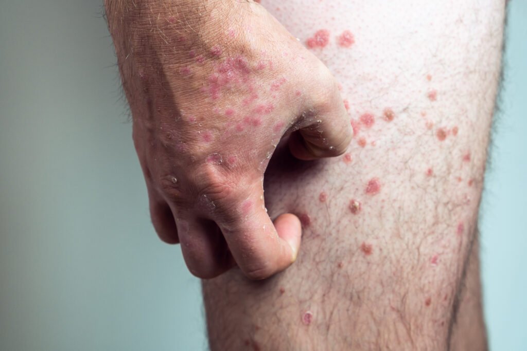 perna de um homem com psoriase que é uma doença de pele