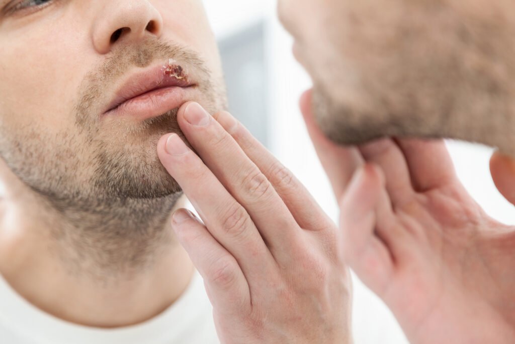 homem com herpes labial