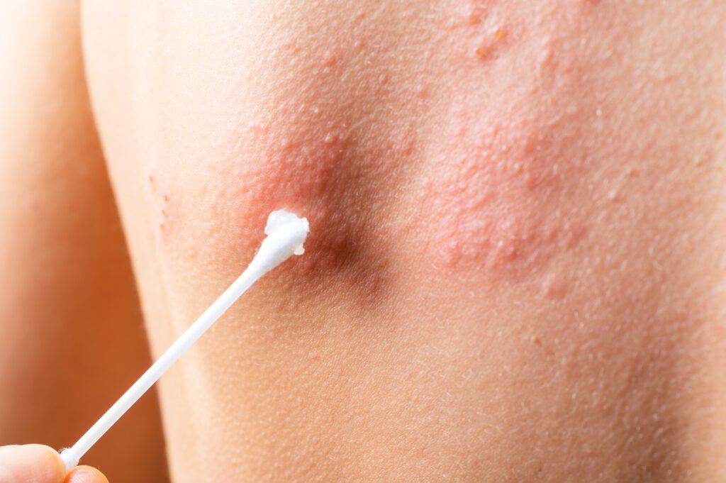 pessoa com herpes zoster