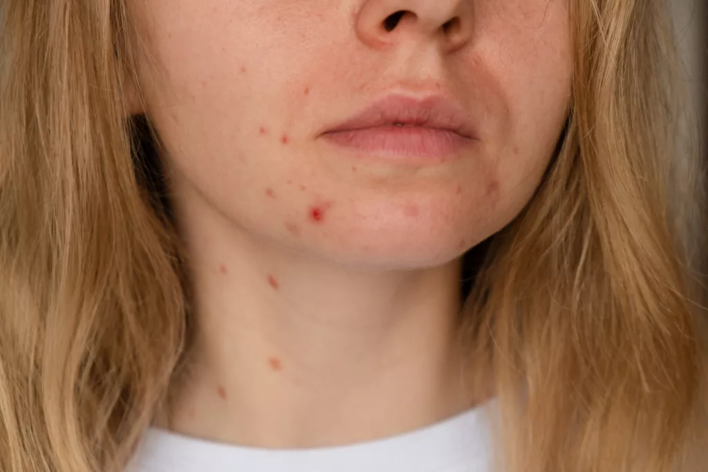 mulher com inflamação na pele devido ao Zyka